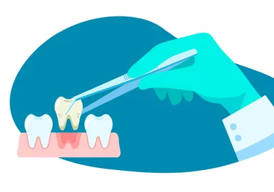 A hand wearing a green glove grabs a decaying tooth from an open mouth.