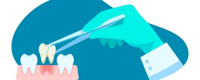 A hand wearing a green glove grabs a decaying tooth from an open mouth.