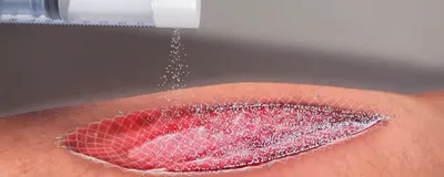 A small bottle is applying spray-on skin treatment to a burn wound.