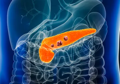 The pancreas is highlighted in orange over a blue-colored outline of the human body. Three red masses inside the pancreas represent pancreatic cancer tumors.