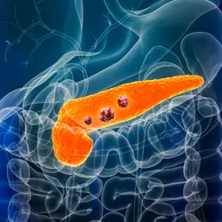 The pancreas is highlighted in orange over a blue-colored outline of the human body. Three red masses inside the pancreas represent pancreatic cancer tumors.