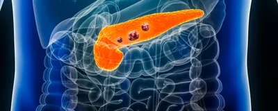 The pancreas is highlighted in orange over a blue-colored outline of the human body. Three red masses inside the pancreas represent pancreatic cancer tumors.