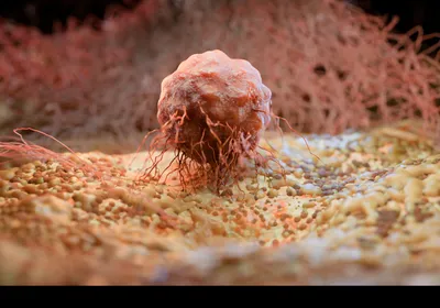 A tumor representing pancreatic cancer is shown with fibers surrounding it, indicating fibrosis.