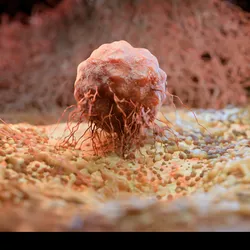 A tumor representing pancreatic cancer is shown with fibers surrounding it, indicating fibrosis.
