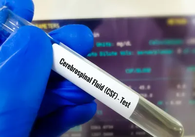 Image of a test tube with cerebrospinal fluid sample.
