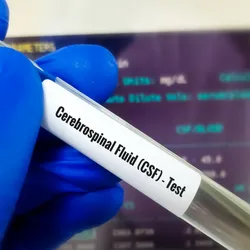 Image of a test tube with cerebrospinal fluid sample.