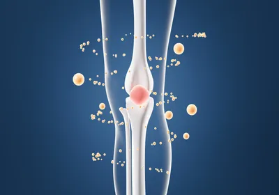 Yellow spheres and one red sphere encircle a knee bone joint, representing extracellular vesicles from menstrual blood stem cells as a treatment for cartilage breakdown in osteoarthritis.