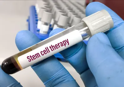 Blood sample for stem cell therapy testing.