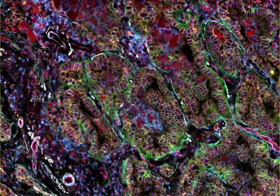 Cross section of human lung adenocarcinoma tissue with multicolored staining.