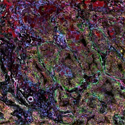 Cross section of human lung adenocarcinoma tissue with multicolored staining.