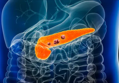 3D rendered illustration of a transparent human lower torso and upper abdomen with the organs outlined. The pancreas is shown in orange and three red tumors are sitting on it to indicate pancreatic cancer. 