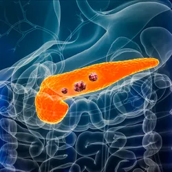 3D rendered illustration of a transparent human lower torso and upper abdomen with the organs outlined. The pancreas is shown in orange and three red tumors are sitting on it to indicate pancreatic cancer. 