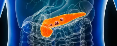 3D rendered illustration of a transparent human lower torso and upper abdomen with the organs outlined. The pancreas is shown in orange and three red tumors are sitting on it to indicate pancreatic cancer. 