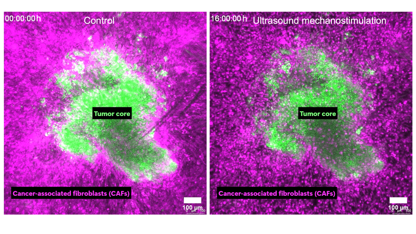 A microscopy image showing some green cells surrounded by dense, magenta cells on the left, signifying control treatment group, with the pink cells reducing in numbers on the right, signifying ultrasound-treated cells.
