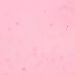 Calcium oxalate crystal in urine analysis, signifying the target of a new RNAi therapeutic.