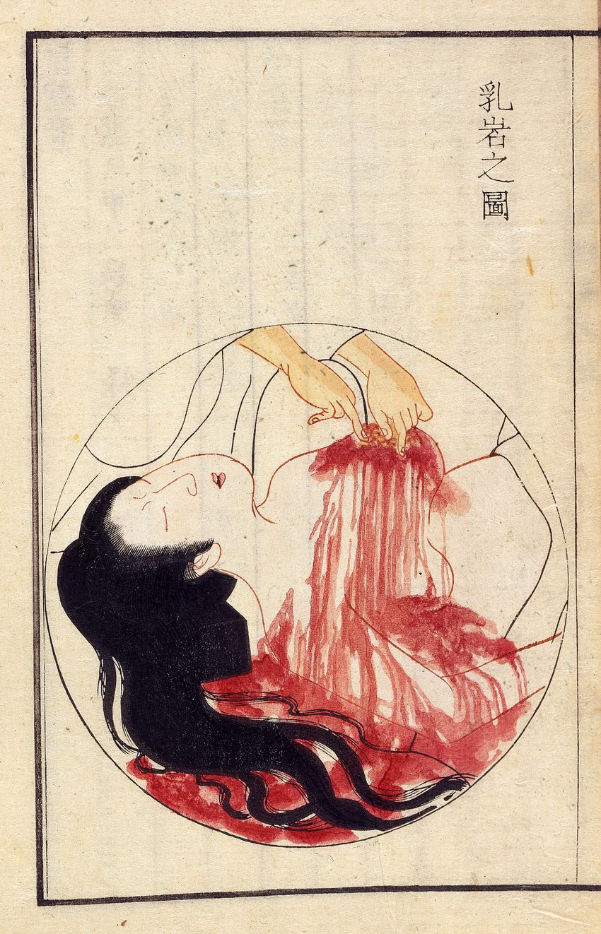 A Japanese illustration shows a womans breast tumor being operated on under general anesthesia in 1804.