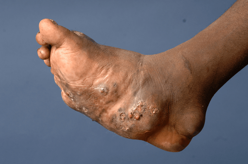 A photograph showing the mycetoma triad of swelling, multiple discharging sinuses, and black grains on a patient