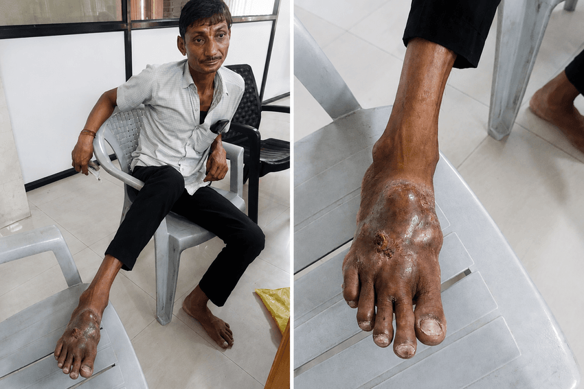 In the left panel, Kishan Ram sits in a chair and props his right foot with a mycetoma infection up onto a chair. The right panel shows a closeup of his foot with the infection.