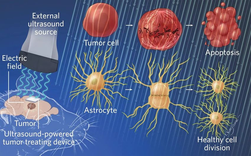 An infographic depicting the mechanism of action of an ultrasound-powered device that helps treat tumors while sparing healthy cells.