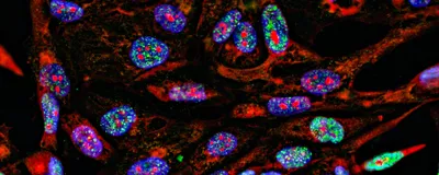 Immunofluorescent cancer cells with nuclei stained in blue, cytoplasm stained in red, and DNA damage in green.