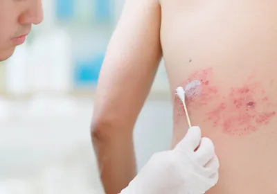 A doctor applies ointment to a shingles rash on a person’s back.