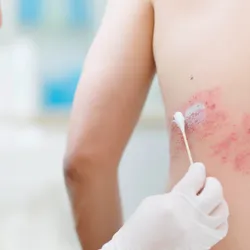 A doctor applies ointment to a shingles rash on a person’s back.