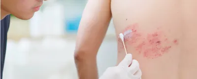 A doctor applies ointment to a shingles rash on a person’s back.