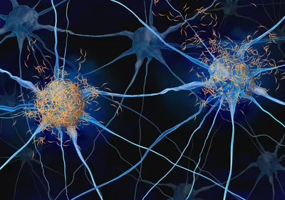 Tau tangles surrounding neurons. 