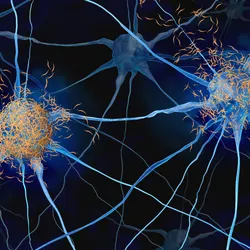 Tau tangles surrounding neurons. 