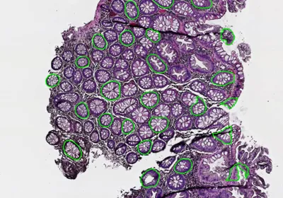 An image of a biopsy in purple where the tumor has been circled in green by QuantumCyte’s tool.